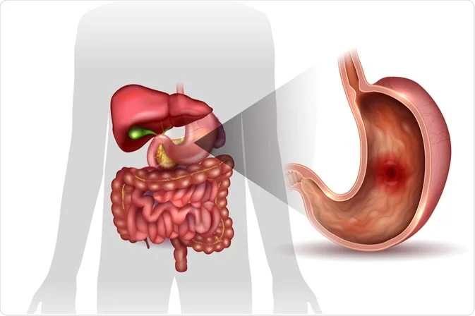 Top các phương pháp điều trị viêm loét dạ dày hiệu quả